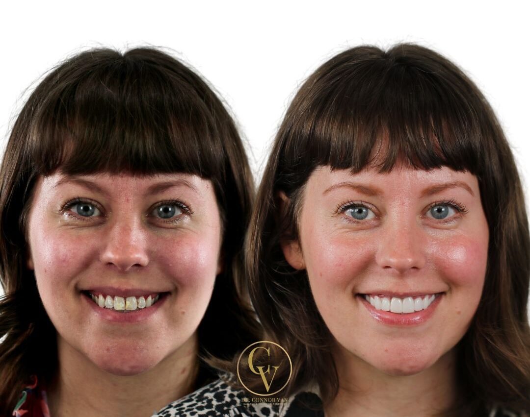 DeLand Dental Implant Before and After 8