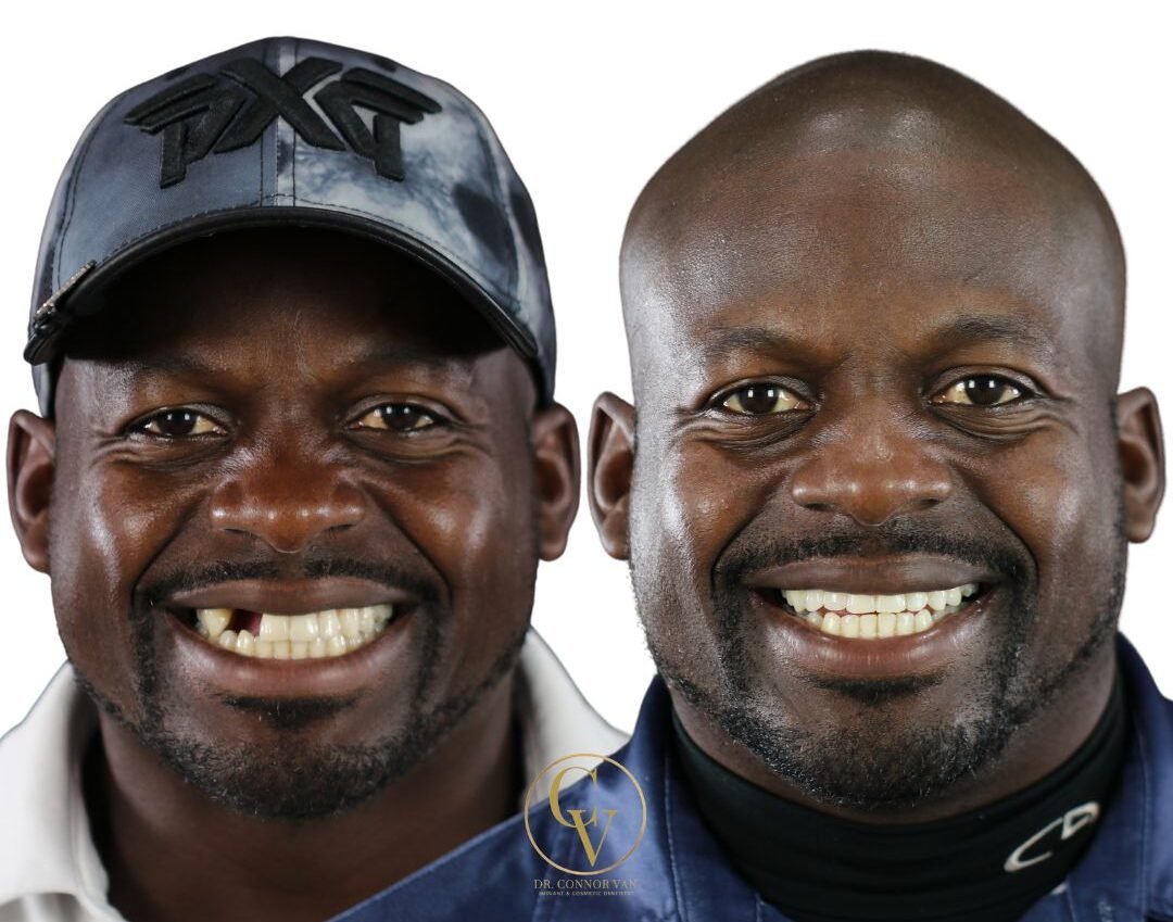 DeLand Dental Implant Before and After 9