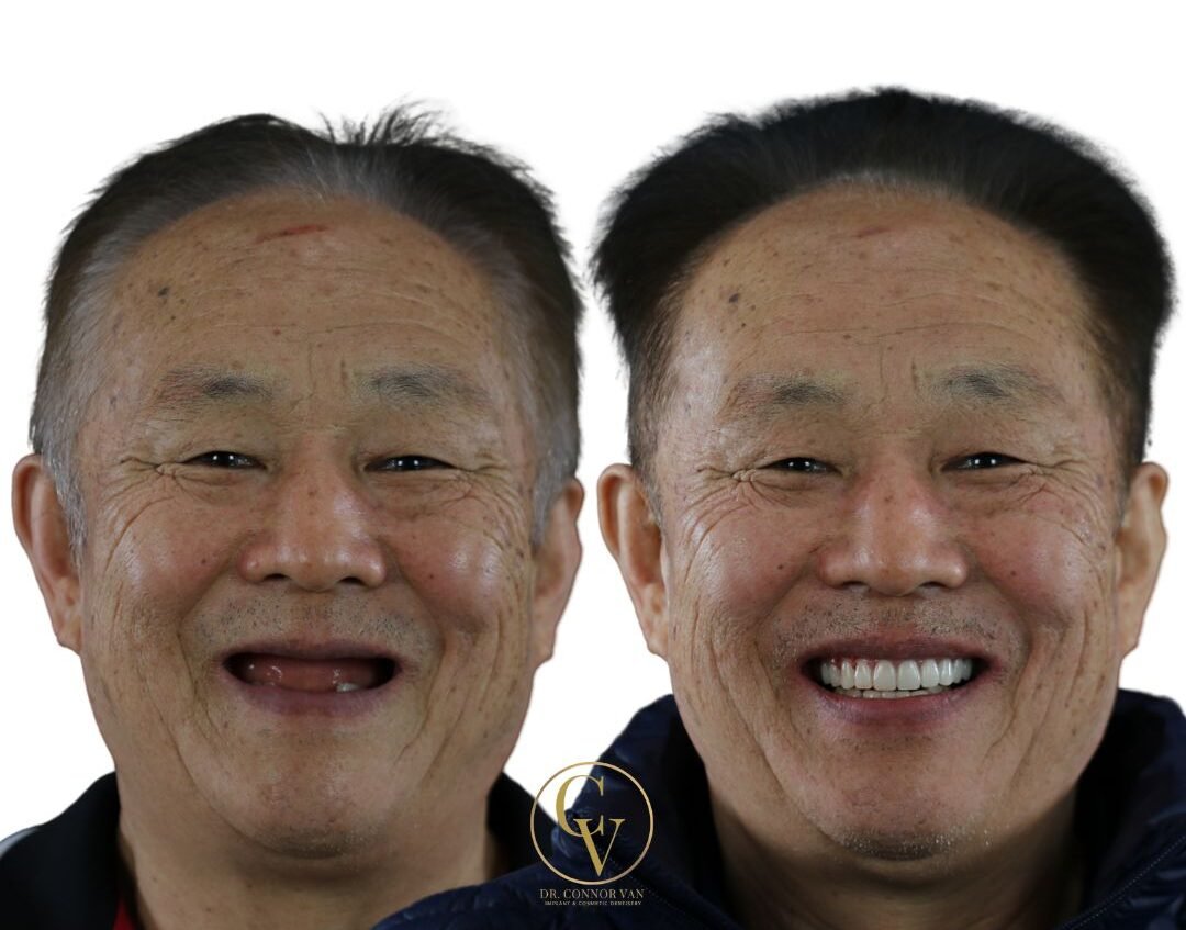 DeLand Dental Implant Before and After 2