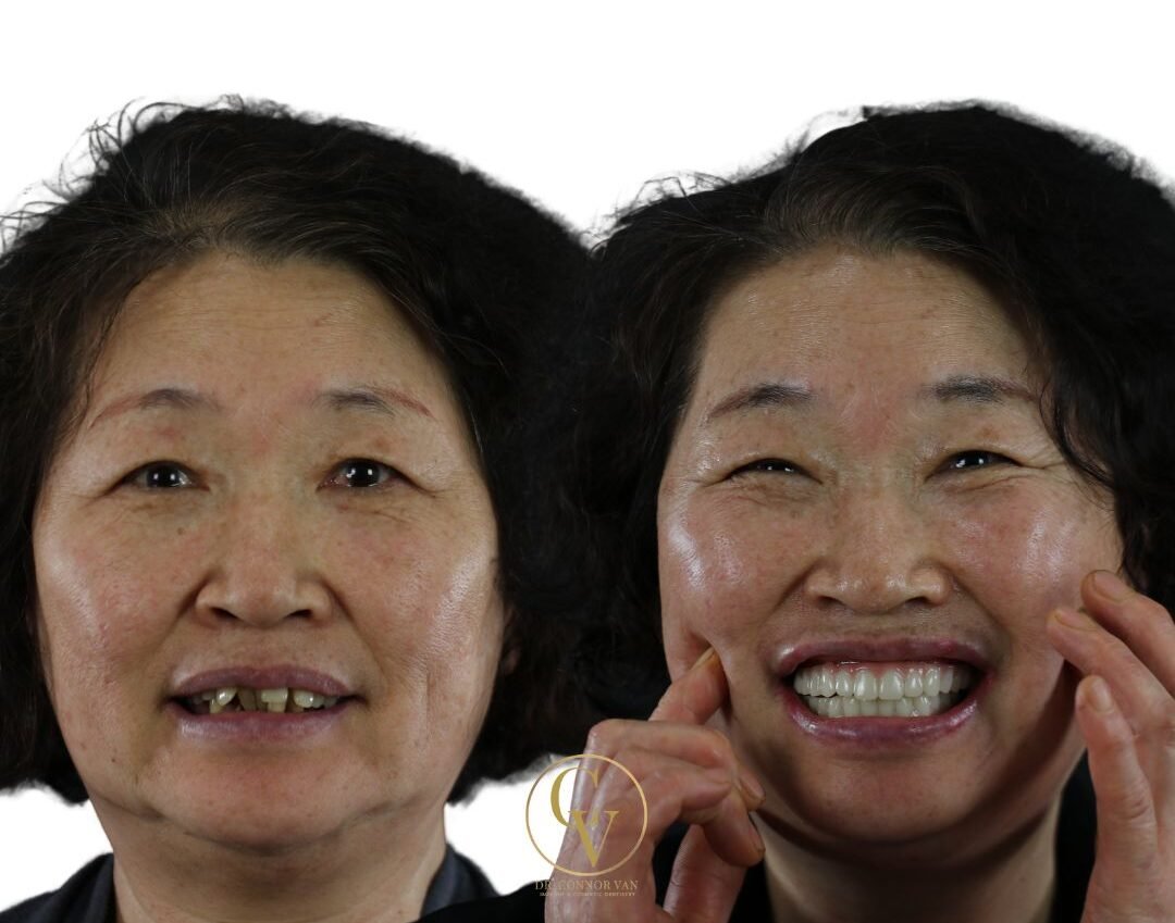 DeLand Dental Implant Before and After 3