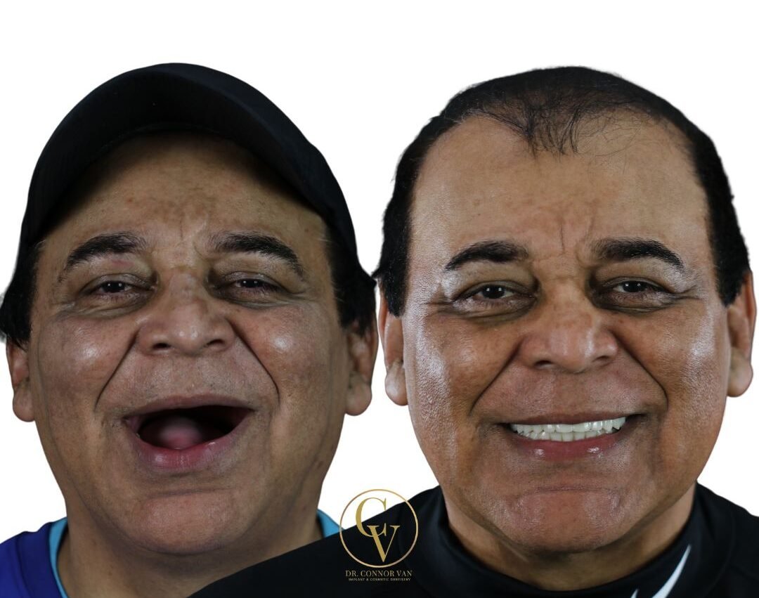 DeLand Dental Implant Before and After 6