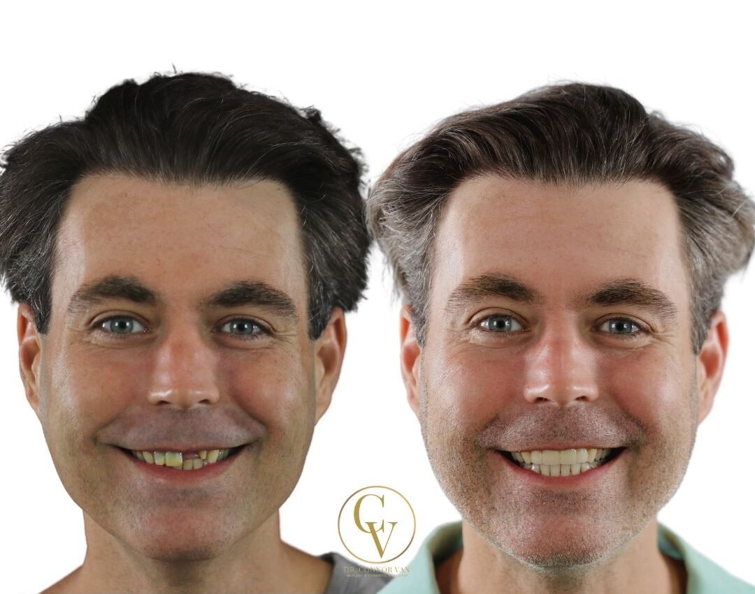 DeLand Dental Implant Before and After 7